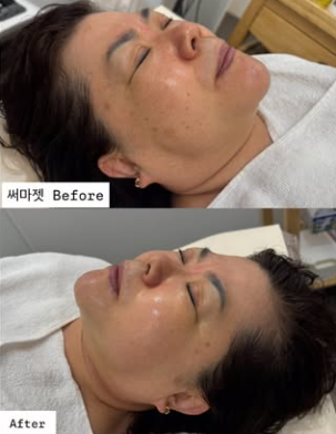 써마젯 시술 전후 비교 사진